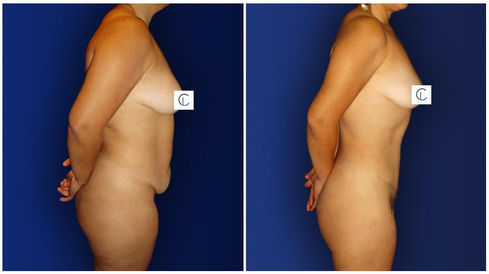 0-march-tummytuck-2